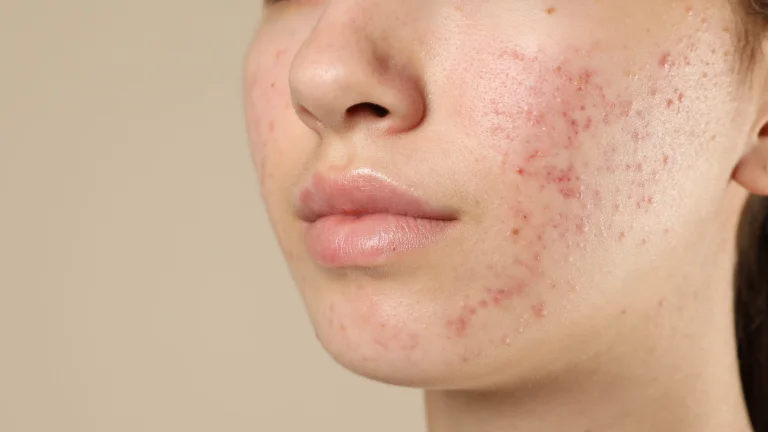 Dermapen Uygulaması Hangi Cilt Sorunlarında Kullanılır?