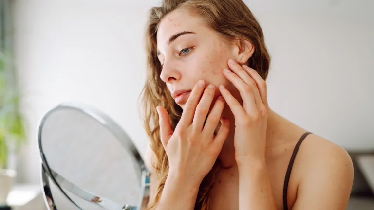 Seboreik Dermatit: Belirtileri ve Tedavisi